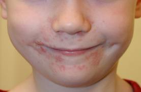 perioral dermatitis